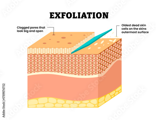 Exfoliation. Peeling or Physically scrubbing procedure. Removal of the old dead cells to surface. Clogged pores, Human skin layers anatomy cross section. Vector illustration