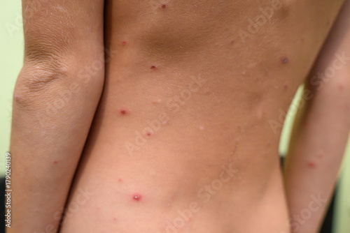 Boy with chickenpox. Rash on child body 