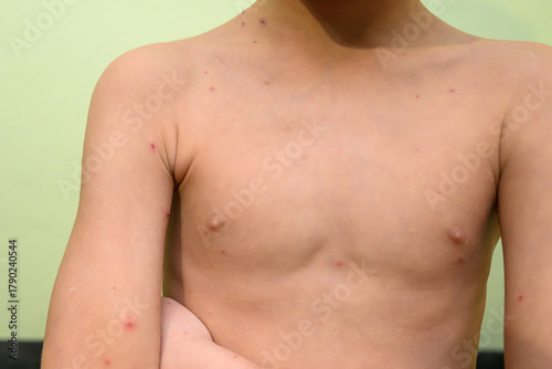 Foto Boy with chickenpox. Rash on child body
