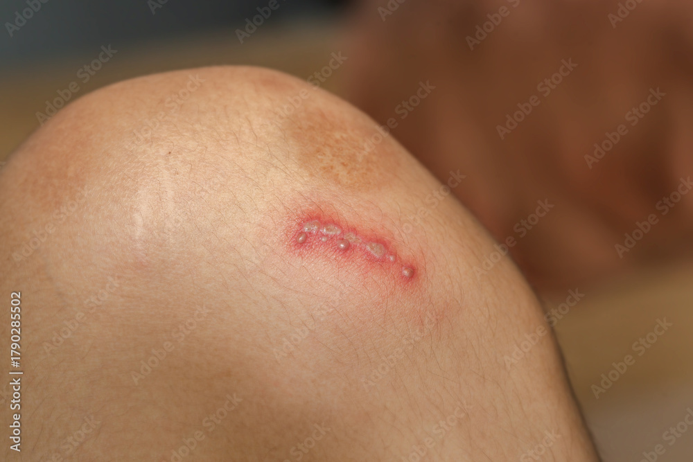Naklejka premium Rove beetles cause a burning sensation, and a rash of blisters. itch red spot or rash of skin. Legs of a teenager with severe atopic eczema. dermatitis. Dermatological skin diseases concept.