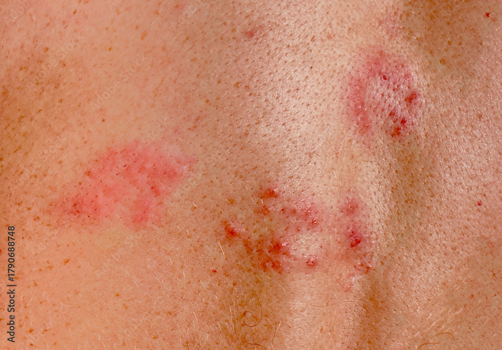 Fototapeta premium Herpes zoster infection on human skin. Skin disease background. Viral infection on human skin, acne, psoriasis, eczema, herpes, lichen, melanoma.