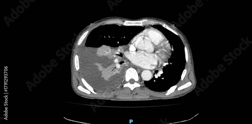 CT scan of chest showing lungs, heart and thoracic cavity. Axial view computed tomography imaging for diagnostic radiology examination of respiratory system and mediastinum
