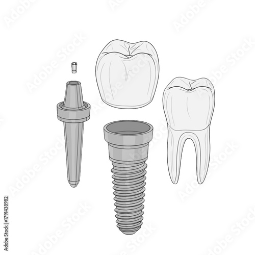 Tooth implant model vector for dental clinic presentation or Dentist Day educational material