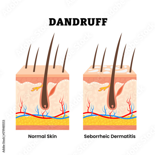 Dandruff. Seborrheic dermatitis on dry skin. Bacteria and fungus on formation the flakes scalp. Dermatitis. Human skin layers anatomy cross section. Vector illustration