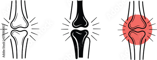 Knee joint illustration, normal, inflamed, painful, orthopedic condition, anatomy chart, medical comparison, arthritis, injury, joint health, diagnosis