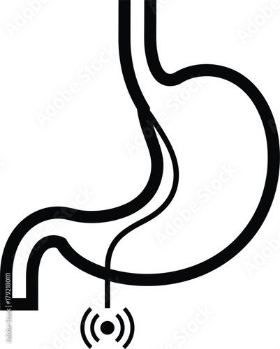 Gastric Electrical Stimulation Illustration Vector Diagram Digestive System Treatment Concept