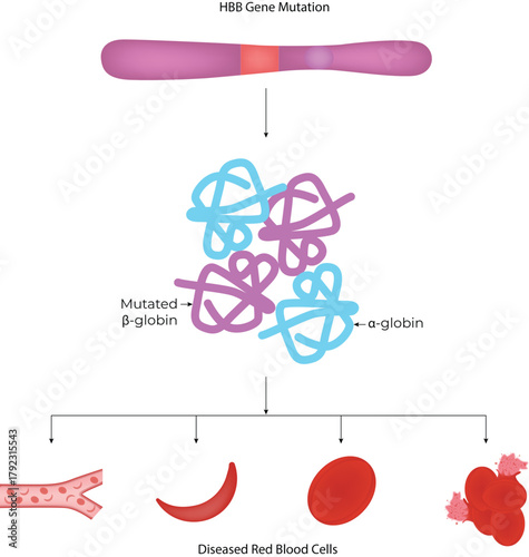 HBB Gene Mutation and Sickle Cell Anemia Pathophysiology Vector Illustration