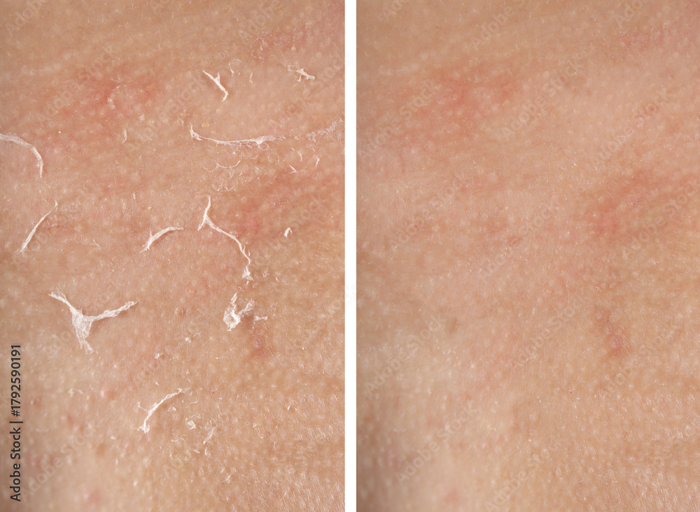 Fototapeta premium Dry skin before and after moisturizing, marco view. Collage for comparison
