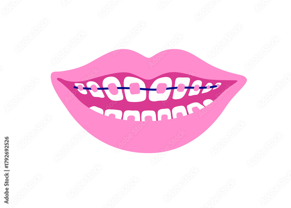 Fototapeta premium Smiling mouth with dental braces. Smiling teeth. Orthodontic Treatment Concept. Vector isolated illustration.