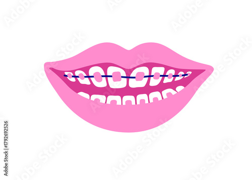 Smiling mouth with dental braces. Smiling teeth. Orthodontic Treatment Concept. Vector isolated illustration.