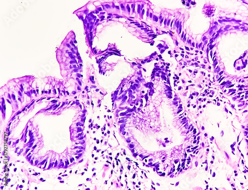 Bilde på lerret Endoscopic biopsy of oesophagus, microscopically show hyperplastic oesophageal mucosa, focal basal cell hyperplasia, papillae lamina propria