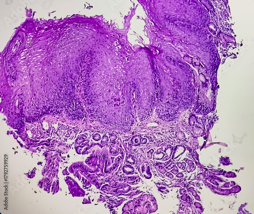 Endoscopic biopsy of oesophagus, microscopically show hyperplastic oesophageal mucosa, focal basal cell hyperplasia, papillae lamina propria. Barrett's oesophagus.