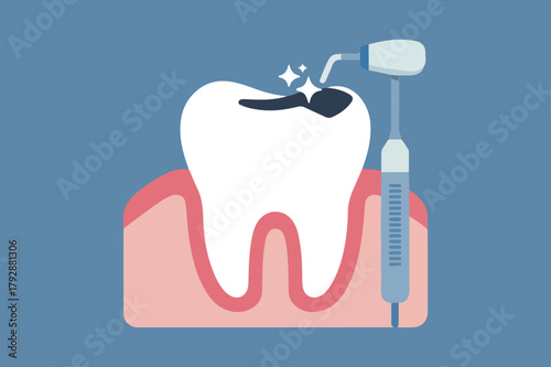 Dental filling procedure on a tooth with a dental drill and filling material