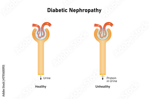 Diabetic Nephropathy Disease Science Design. Vector Illustration.
