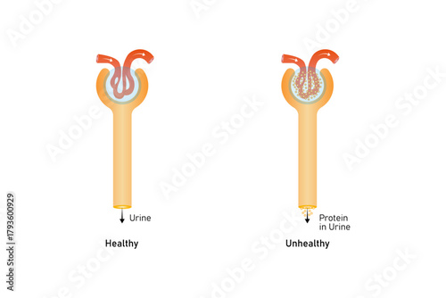Diabetic Nephropathy Disease Science Design. Vector Illustration.