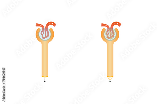 Diabetic Nephropathy Disease Science Design. Vector Illustration.