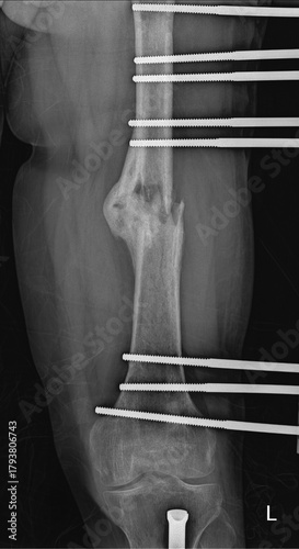 Left Femur X-ray Showing Complex Fracture Stabilized with Rod and Screw Fixation