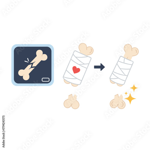 Medical illustration showing the bone fracture healing process, from an x-ray of a broken bone to a cast and final recovery.
