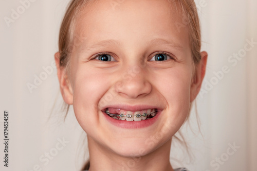Braces Baby Teeth. Child Get Braces With Baby Teeth. Creating space - Braces create more room for Permanent Teeth. Correcting bite. Early intervention.
