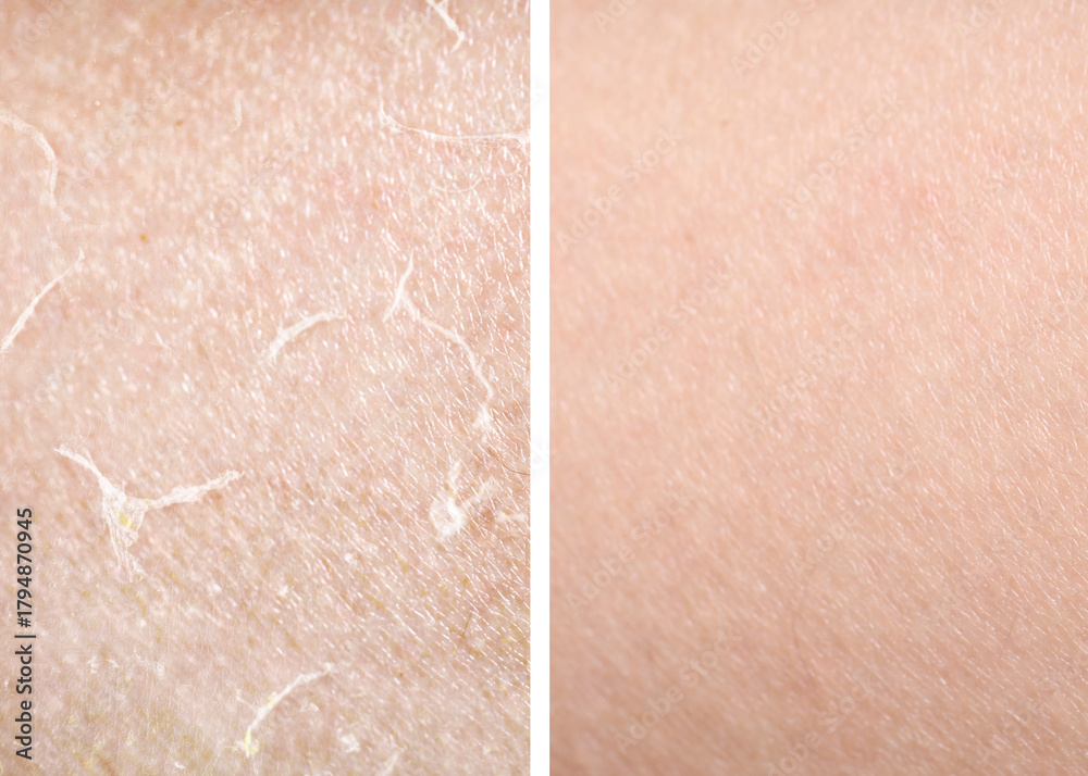 Fototapeta premium Dry skin before and after moisturizing, marco view. Collage for comparison