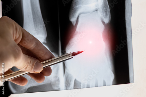 Doctor learning Medical X-ray with sprain and rupture of ankle ligaments. Popular foot trauma ankle dislocation.