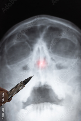 Doctor learning vertical medical X-ray of head Injury. Deviated Nasal Septum. Nose trauma.