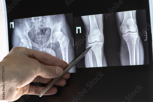 Doctor learn X-ray of dysplastic coxarthrosis. Deformation of the left femoral head. Aseptic necrosis and massive cystic changes in the hip joint. Shortening of the left lower limb by 4.0 cm.