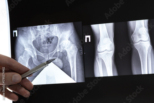 Fotografia Doctor learn X-ray of dysplastic coxarthrosis