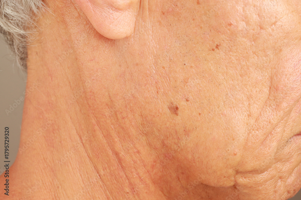 Fototapeta premium Mature man with age spots or liver spots on the side of his face likely cause from sun exposure