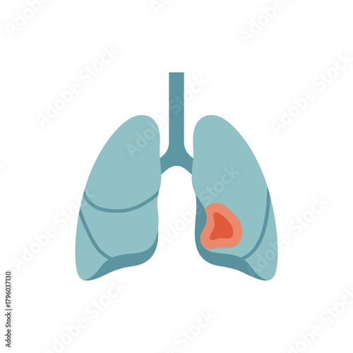 Medical illustration of human lungs showing a highlighted tumor area