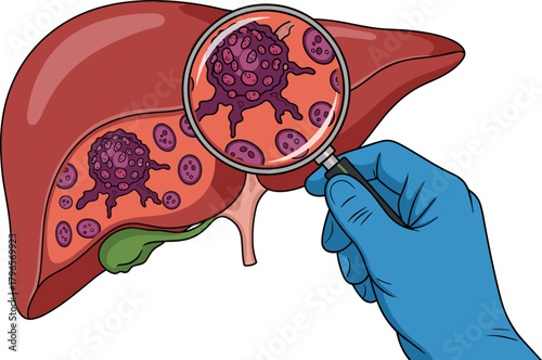 Liver Cancer Illustration, Abnormal Cells in Liver, Medical Diagnosis Concept, Magnifying Glass Examination, Human Organ Pathology, Cartoon Anatomy Design