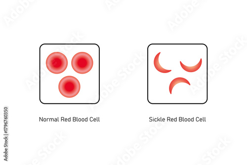 Normal and Sickle Red Blood Cell .Science Design. Vector Illustration.
