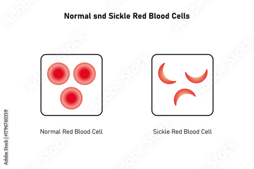 Normal and Sickle Red Blood Cell .Science Design. Vector Illustration.