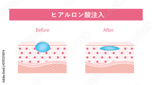 ヒアルロン酸注入　溶けない