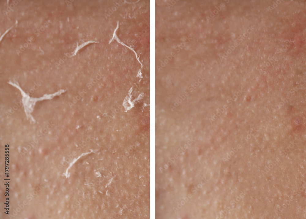 Fototapeta premium Dry skin before and after moisturizing, marco view. Collage for comparison