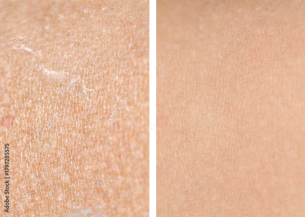 Fototapeta premium Dry skin before and after moisturizing, marco view. Collage for comparison