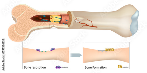Human Bone Remodeling Illustration with Osteoclasts and Osteoblasts. Long Bone Cross Section Showing Resorption and Formation Stages