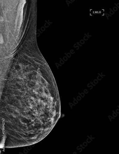  X-ray Digital Mammogram of Both side CC view and MLO view showing multiple cysts and complicated cysts scattered at bilateral breasts. BI-RADS CATEGORY 3: Probably benign.