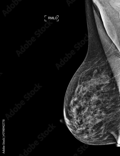  X-ray Digital Mammogram of Both side CC view and MLO view showing multiple cysts and complicated cysts scattered at bilateral breasts. BI-RADS CATEGORY 3: Probably benign.