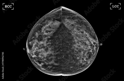  X-ray Digital Mammogram of Both side CC view and MLO view showing multiple cysts and complicated cysts scattered at bilateral breasts. BI-RADS CATEGORY 3: Probably benign.