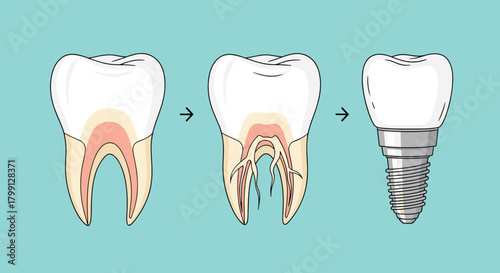 Diagram illustrating the process of root canal treatment and tooth implantation.