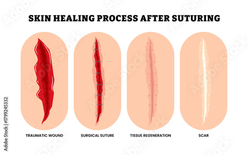 Skin healing process after suturing closure procedure. Wound healing process, Labeled traumatic wound, surgical suture, tissue regeneration and scar formation. Flat vector illustration.