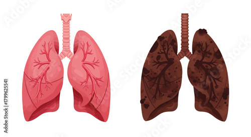 Medical illustration comparing healthy pink lungs and diseased black smoker's lungs