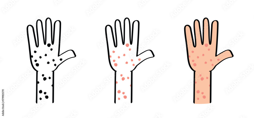 Fototapeta premium Skin rash, measles on hand. allergy causing itching, skin irritation. Red rash on the body. food allergy orother autoimmune diseases. Rubeola or morbilli symptom. food allergy. Eczema, smallpox.