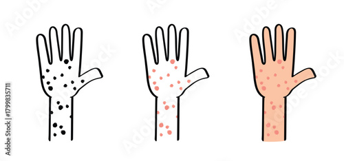 Skin rash, measles on hand. allergy causing itching, skin irritation. Red rash on the body. food allergy orother autoimmune diseases. Rubeola or morbilli symptom. food allergy. Eczema, smallpox.