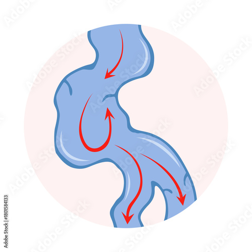 Varicose veins. Blue blood vessel visible through the skin. Vascular disease diagnostic and treatment. Venous insufficiency medical