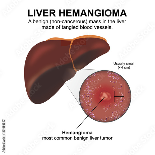 Liver Hemangioma - most common benign liver tumor