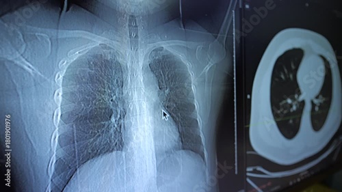 A close-up view of a digital chest X-ray and axial CT scan displayed on a medical workstation screen.