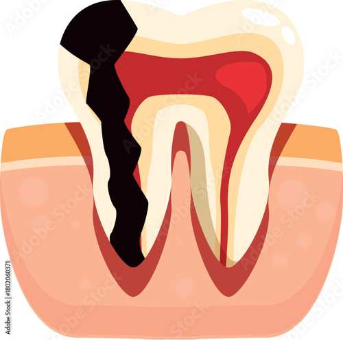 Cross section of molar showing progressive decay and inflammation, emphasizing dental health and hygiene