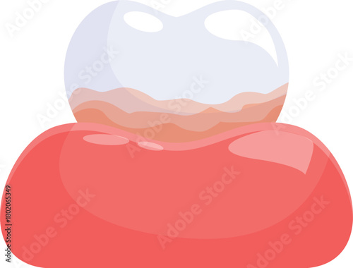 Plaque accumulating on tooth causing gingivitis and requiring urgent intervention by dentist